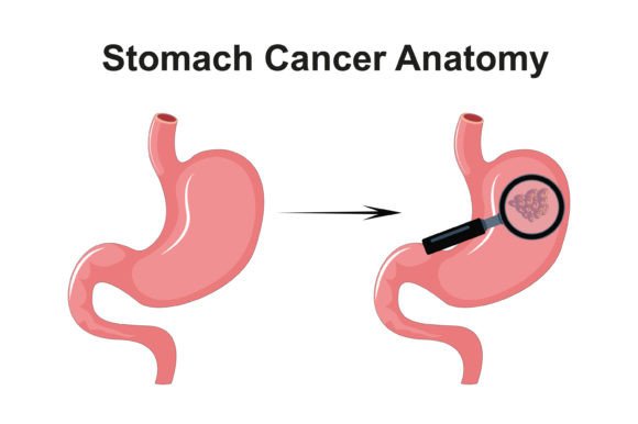Download Stomach Cancer Anatomy Diagram Vector - Diagram Collection