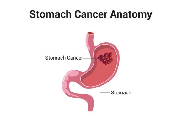 Download Stomach Cancer Anatomy Diagram Vector - Diagram Collection